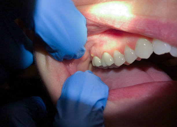 Best Emergency Care for Gum Disease in River Falls, WI